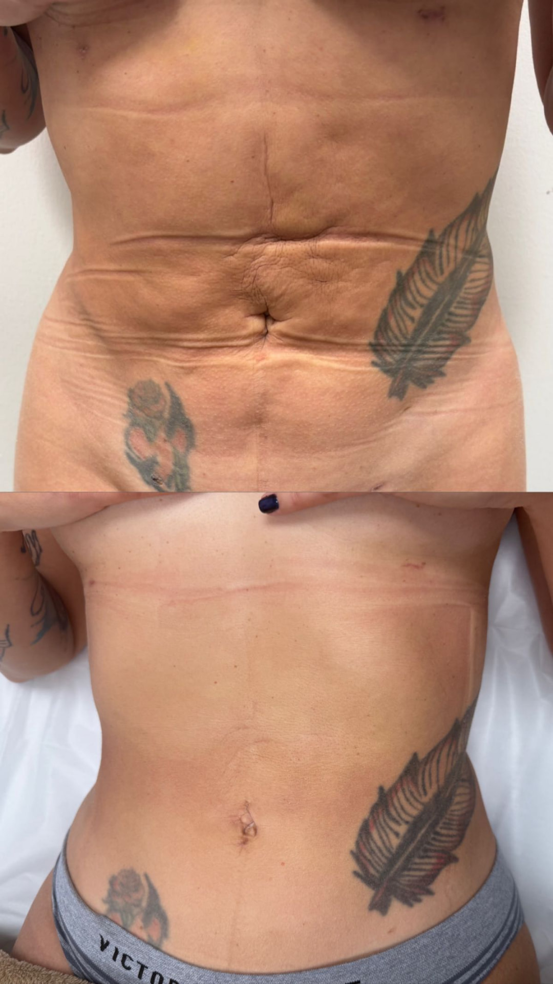 Resultado post-operatorio