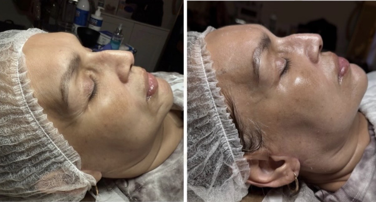 Resultado facial